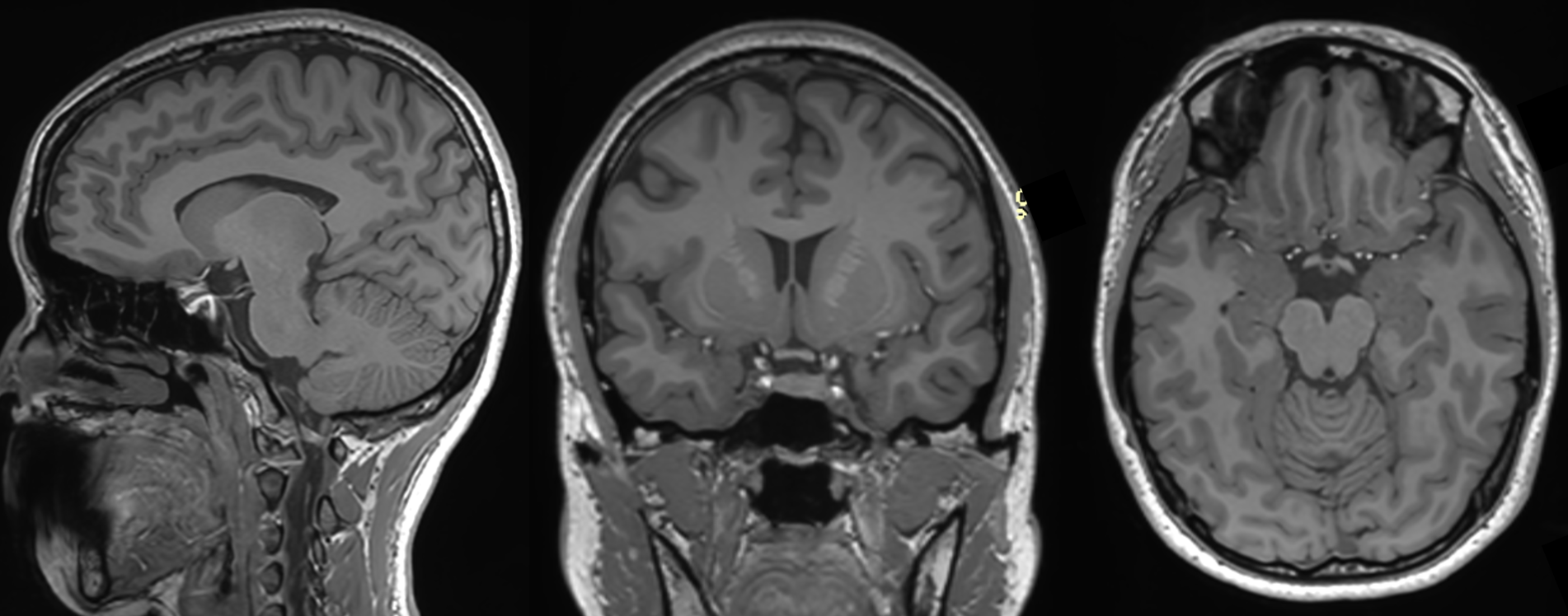 Axial, coronal, Sagital images of the brain MRI
