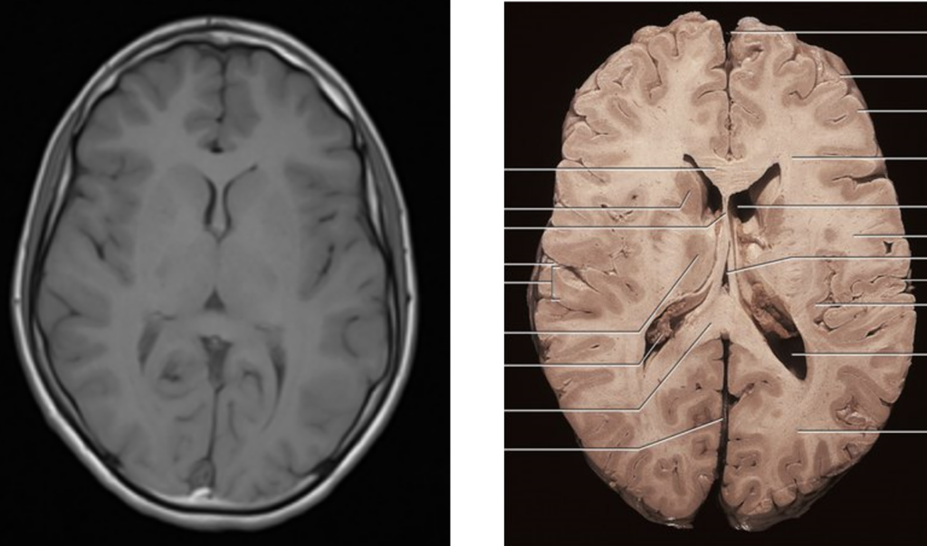 Magnetic Resonance Imaging (MRI) | Johns Hopkins Medicine