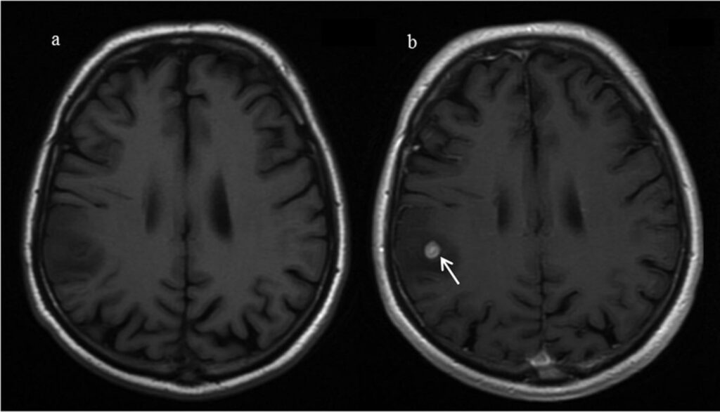 normal brain mri with contrast