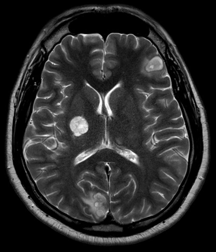 Cranial MRI images of the patient. (A and B) T1 images revealed... |  Download Scientific Diagram