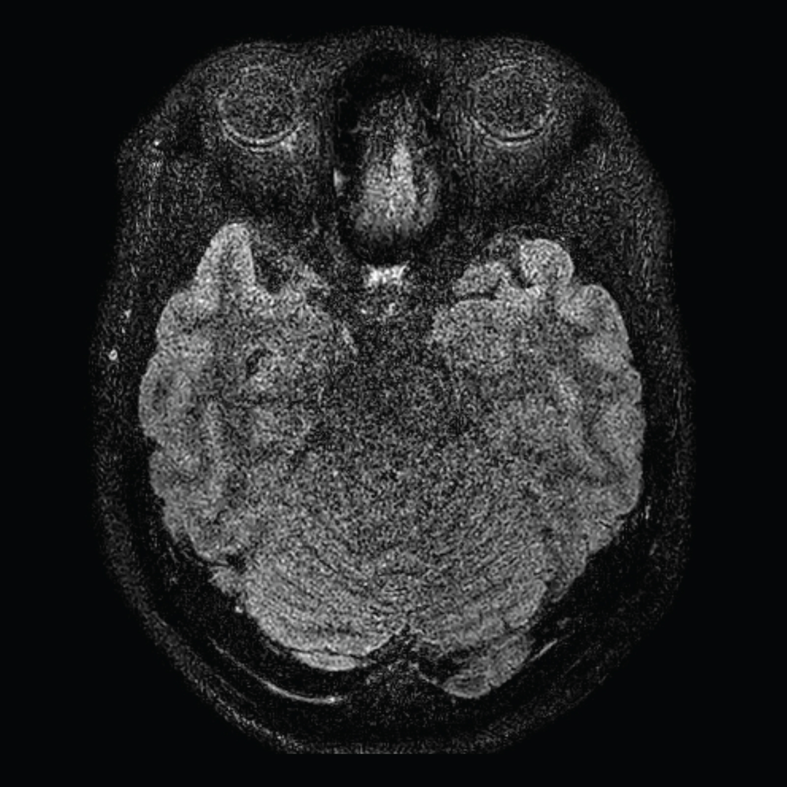 MRI Scan, Brain with Conventional Scanner
