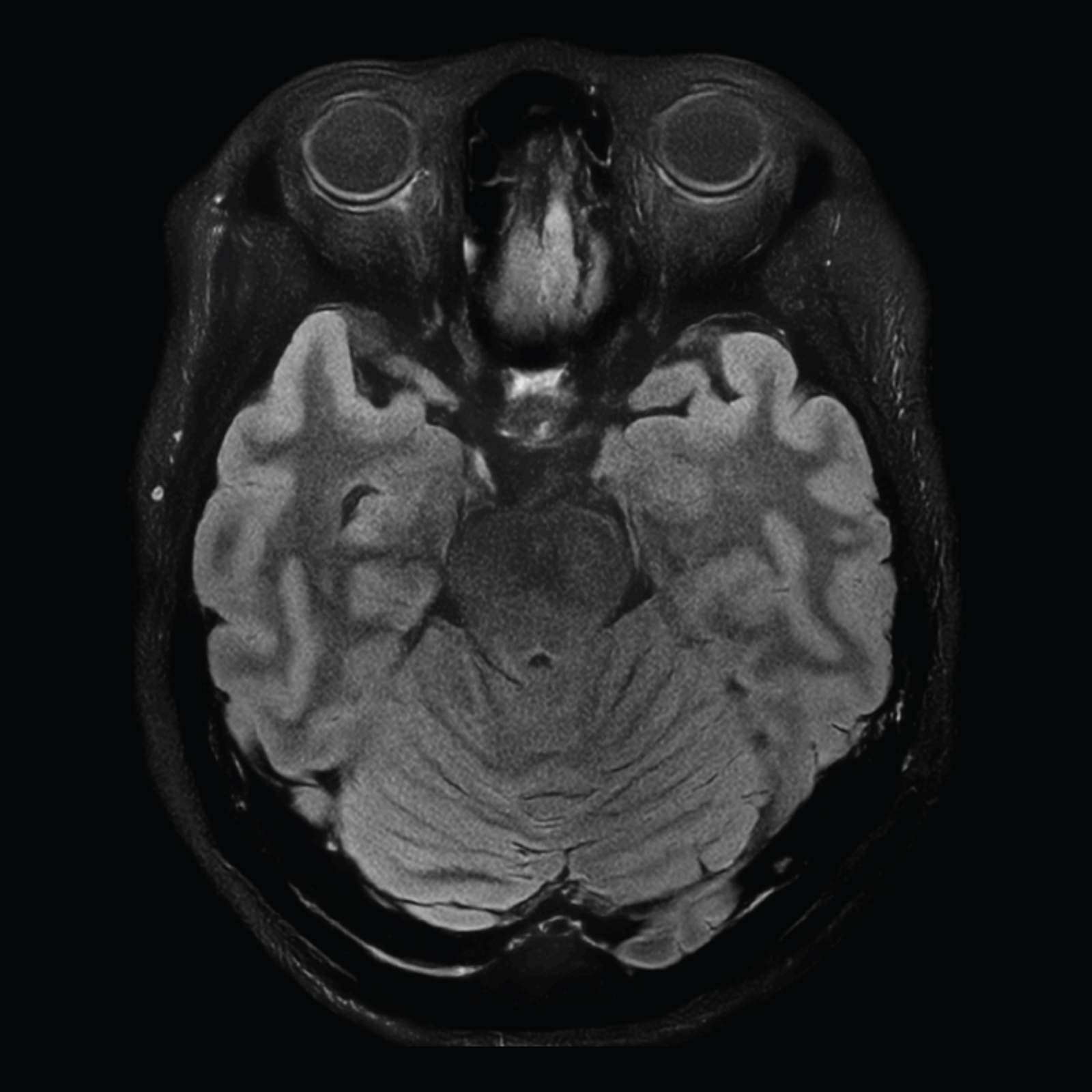 MRI Scan, Brain with SwiftMR