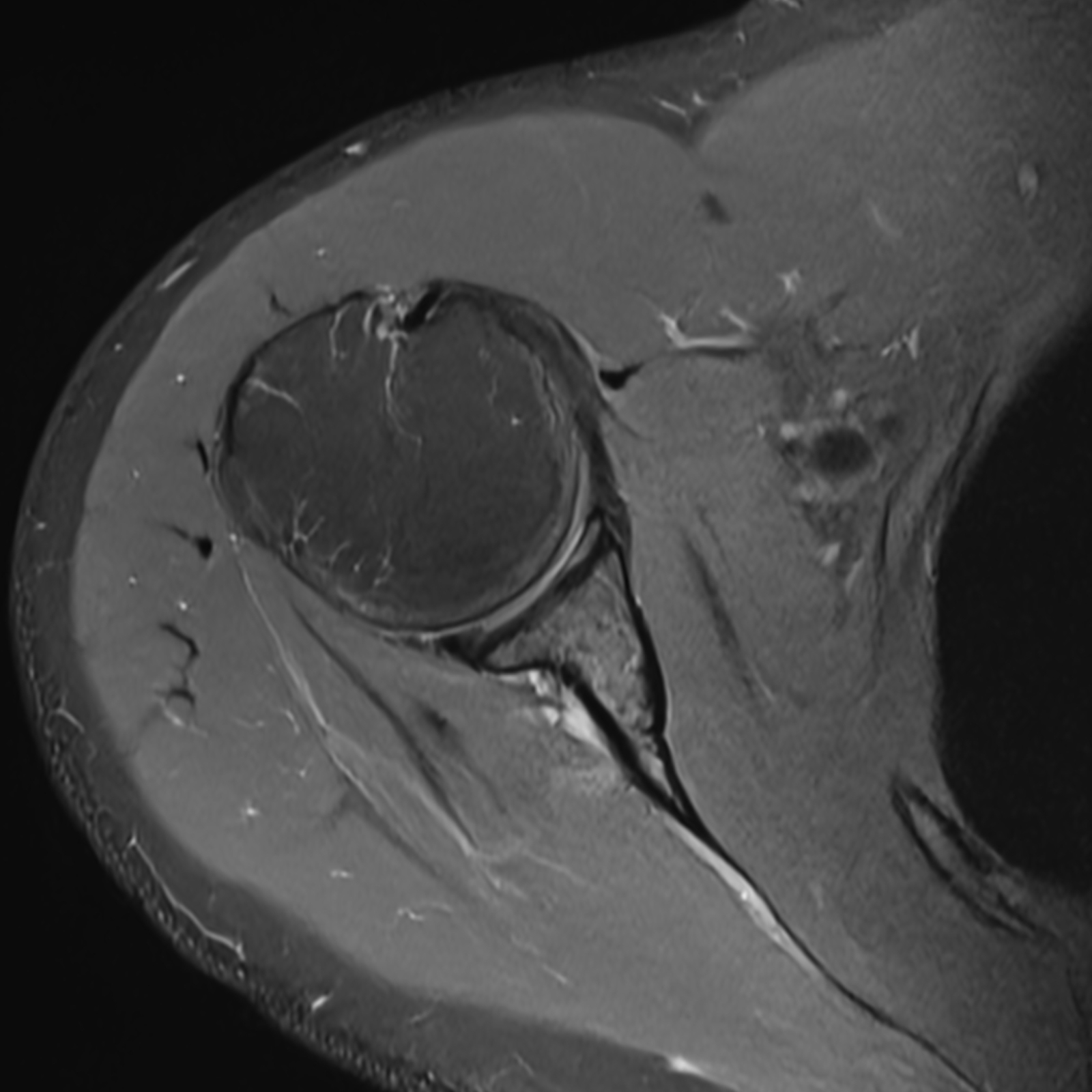 MRI Scan, Shoulder with SwiftMR
