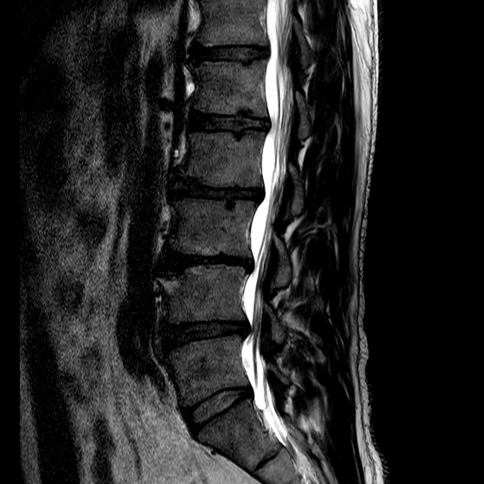 MRI Scan, Spine with Conventional Scanner