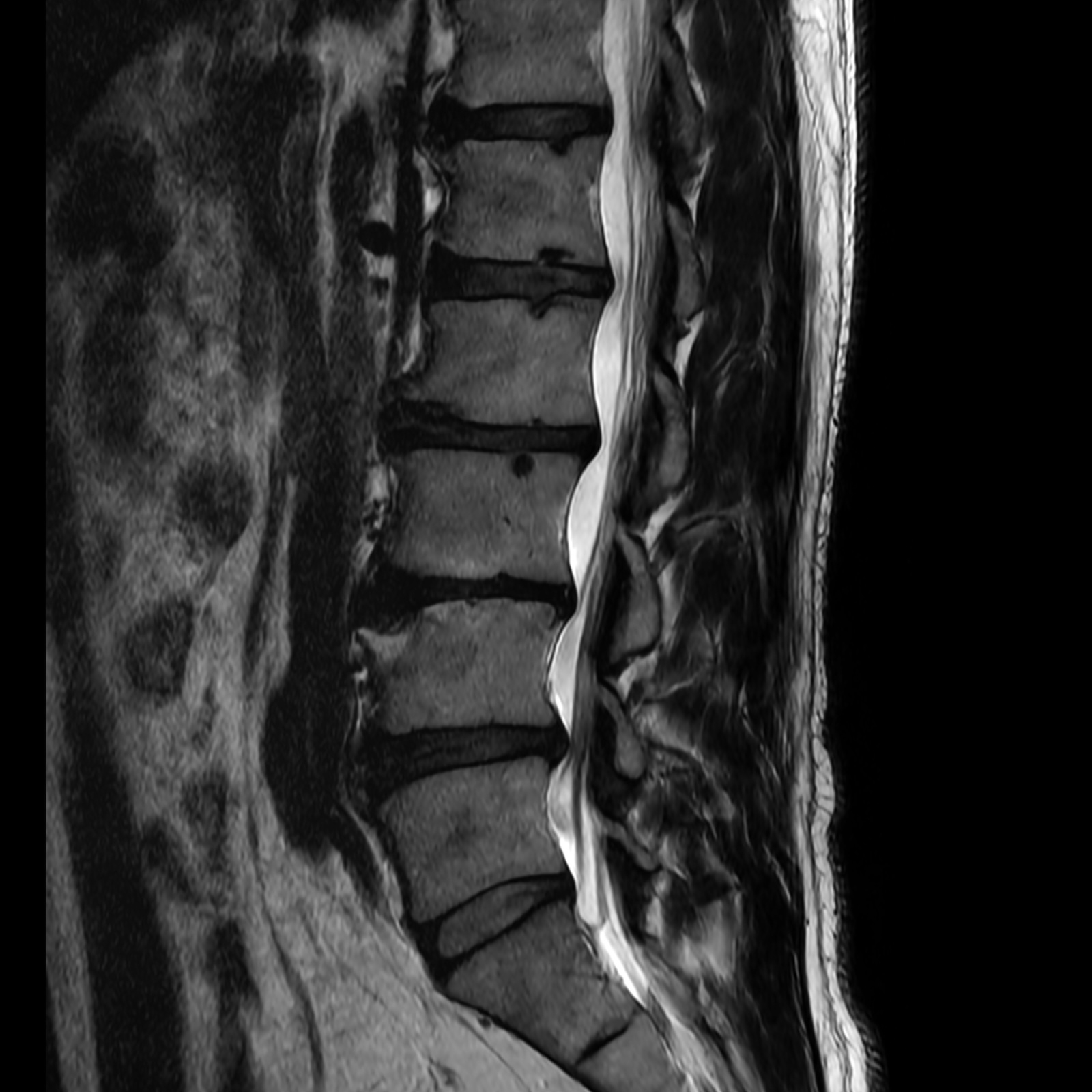 MRI Scan, Spine with SwiftMR