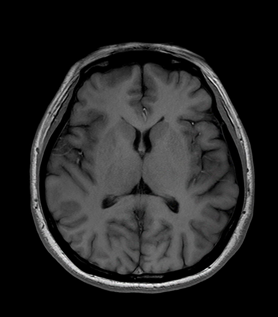 SwiftMR Turbo - Brain - Siemens 3.0T - AX T1WI