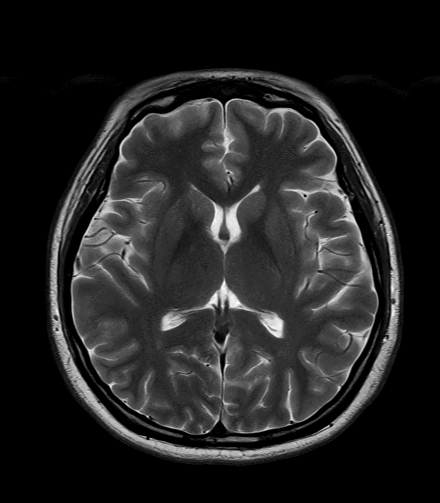 SwiftMR Turbo - Brain - Siemens 3.0T - AX T2WI