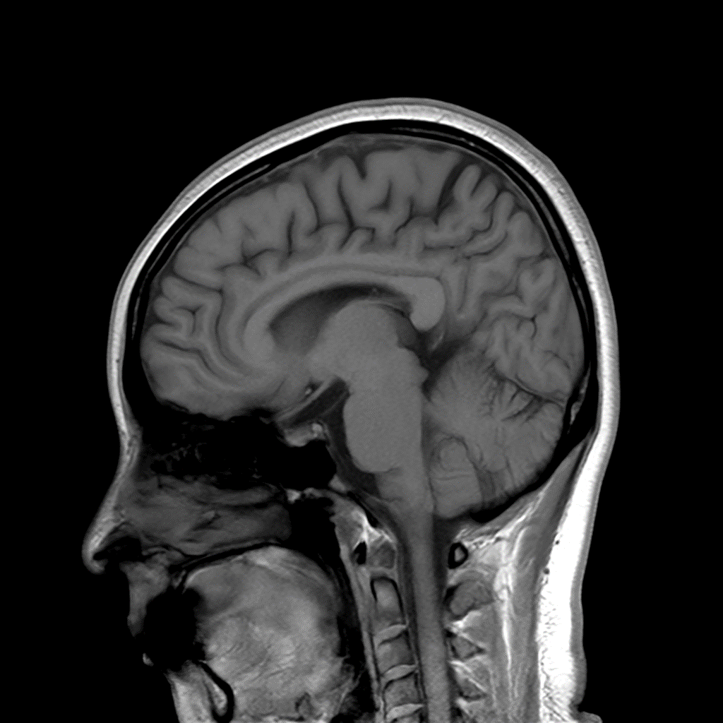 SwiftMR Turbo - Brain - Siemens 3.0T - SAG T1WI