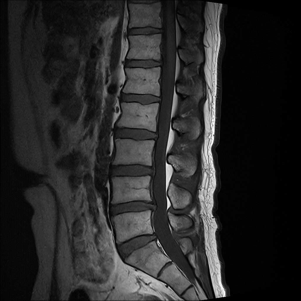 SwiftMR Turbo - L-Spine - Siemens 3.0T - T1WI