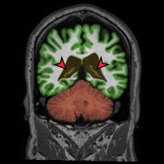 Conventional brain segmentation — limited subcortical detail