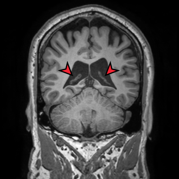 Brain MRI input scan for advanced segmentation analysis
