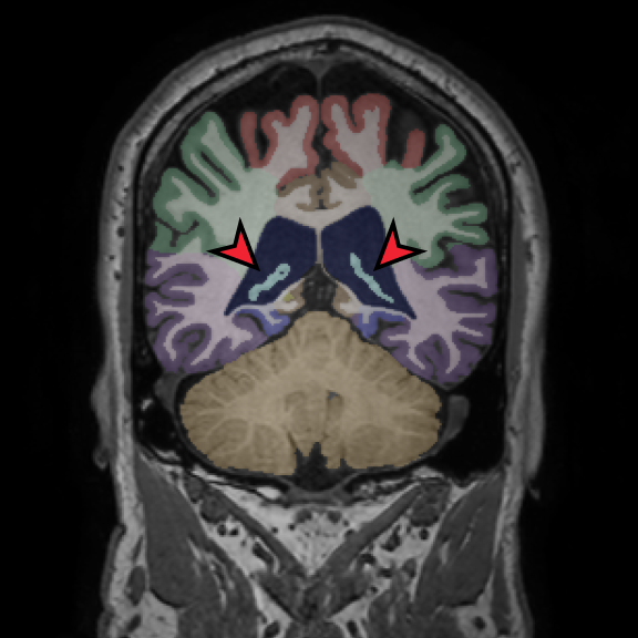 SwiftSight advanced brain segmentation with full lobar and subcortical regions