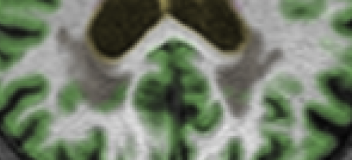 Zoomed view of hippocampal region — conventional segmentation