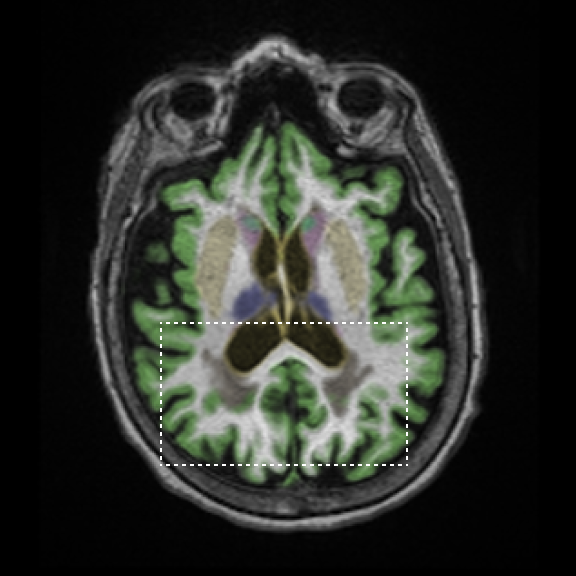 Brain MRI with conventional segmentation