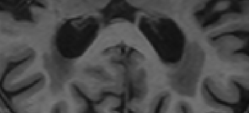 Zoomed view of hippocampal region — input MRI scan