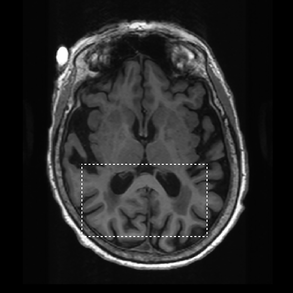 Brain MRI input scan showing hippocampal region