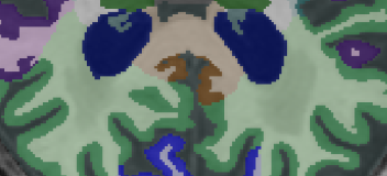 Zoomed view of hippocampal region — SwiftSight AI segmentation