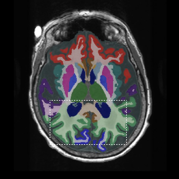 Brain MRI with SwiftSight AI segmentation