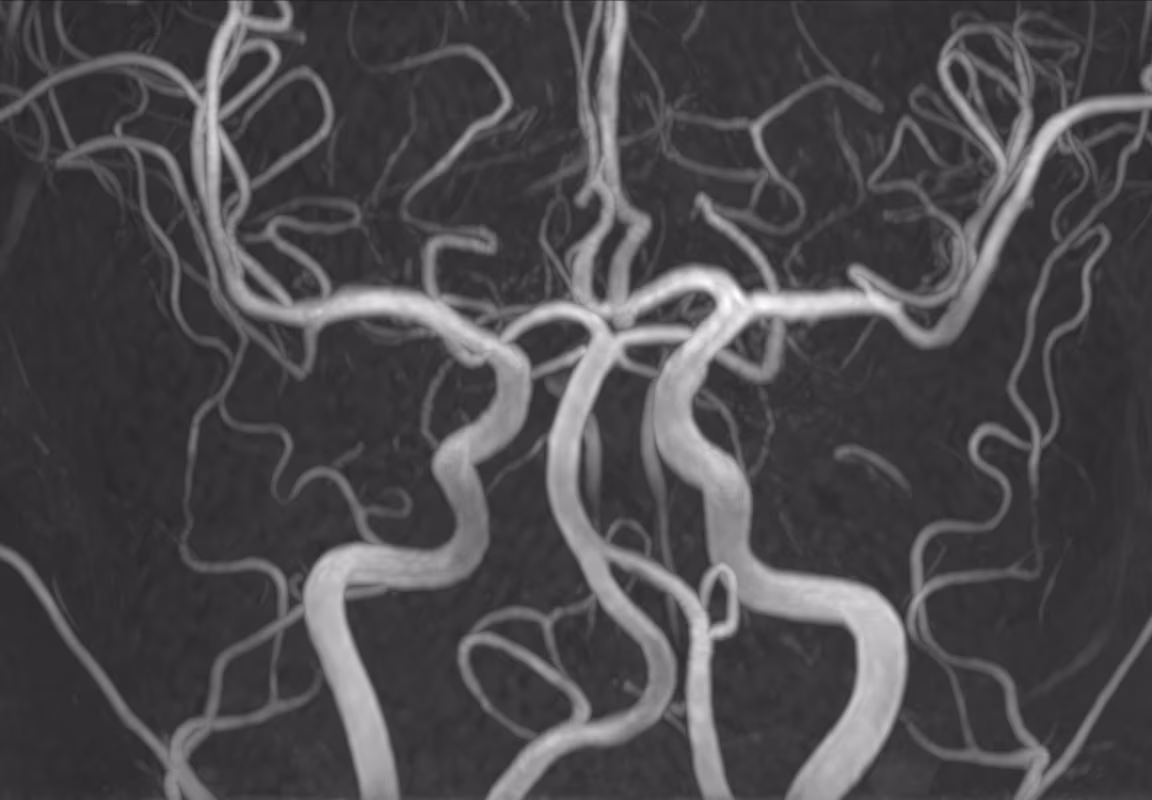 SwiftMR output: Brain MRA in 1:46 (64% faster than conventional)