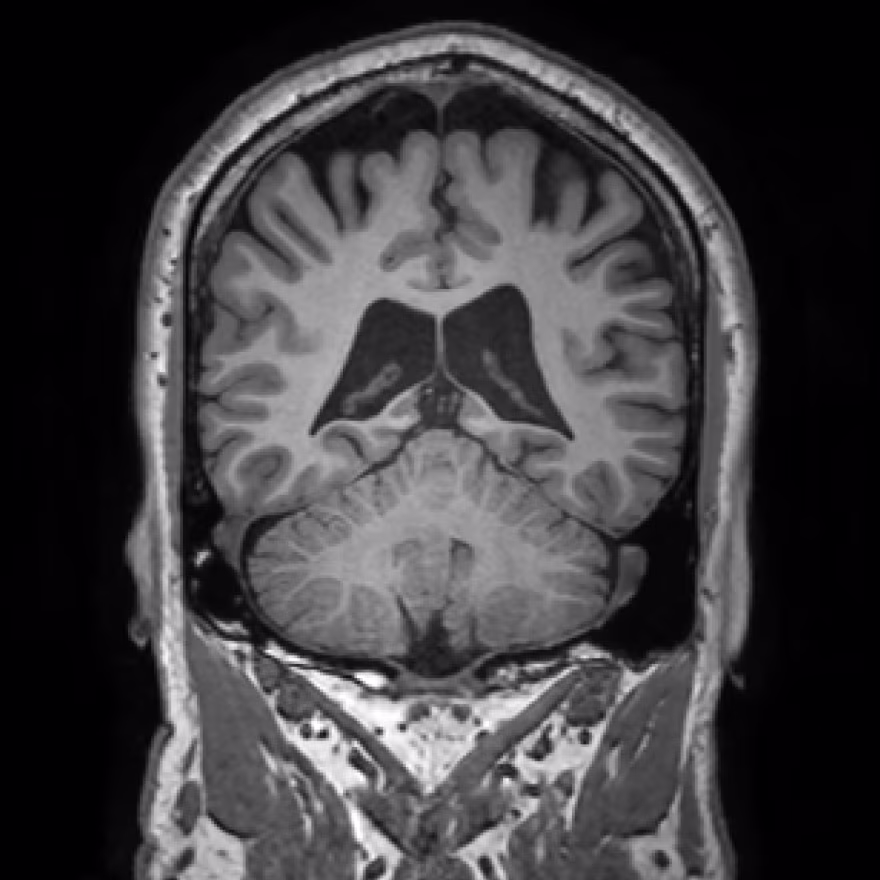 Input MRI brain scan before SwiftSight segmentation