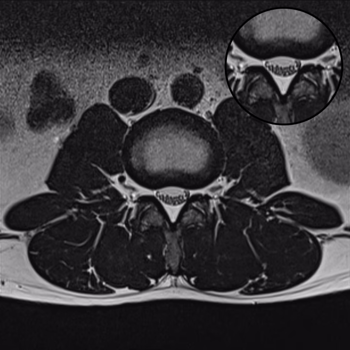 L-SPINE T2WI — conventional MRI scan