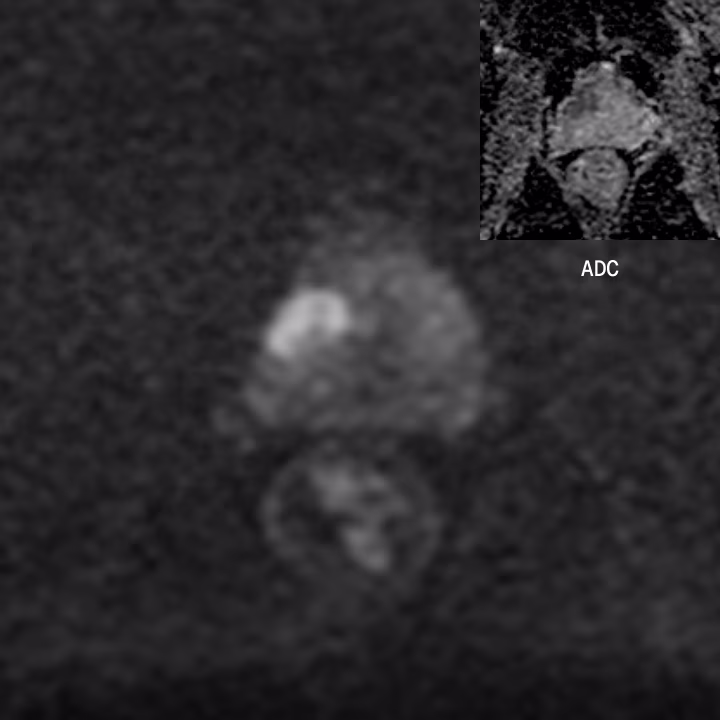 PROSTATE DWI — conventional MRI scan