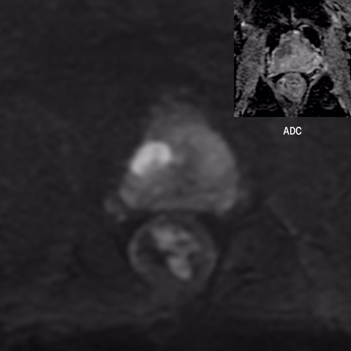 PROSTATE DWI — SwiftMR AI-enhanced scan