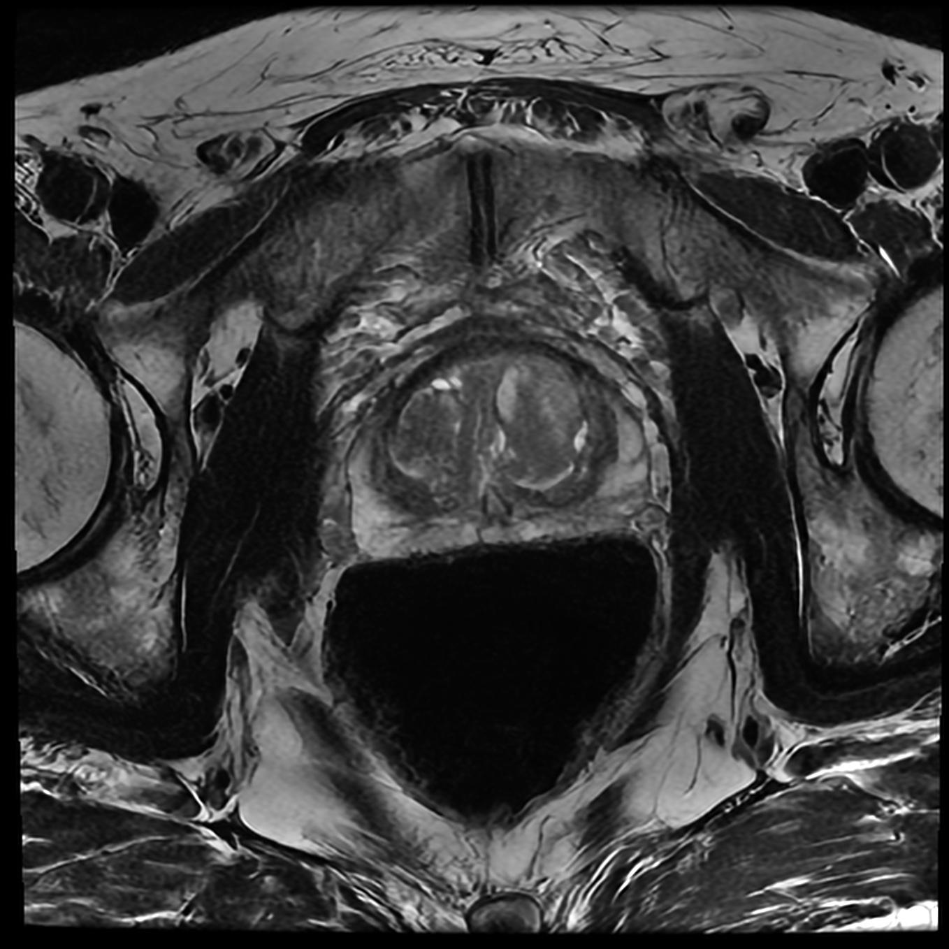 Prostate Ax T2 — SwiftMR