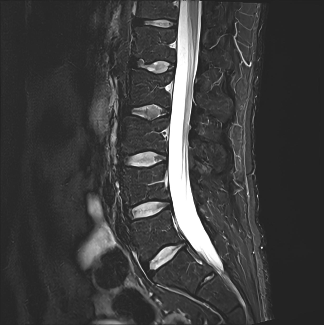 Sag STIR — SwiftMR