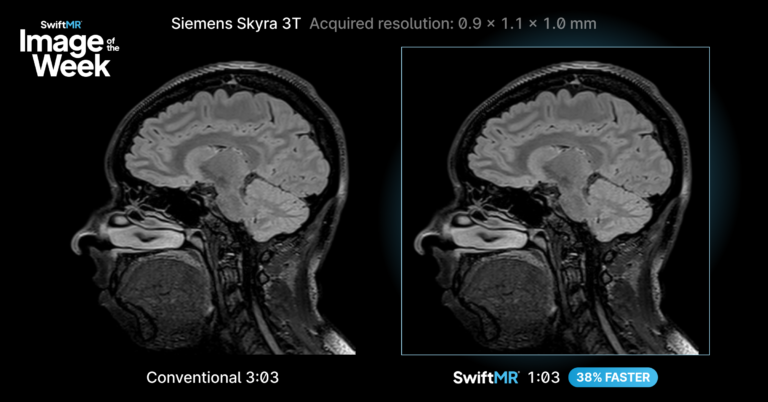 Image showing comparison of two brain images 3D T2 FLAIR for AIRS Medical's SwiftMR Image of the Week
