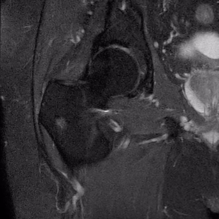 Hip, coronal PD FS, conventional scan