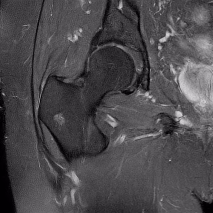 Hip, coronal PD FS, SwiftMR scan