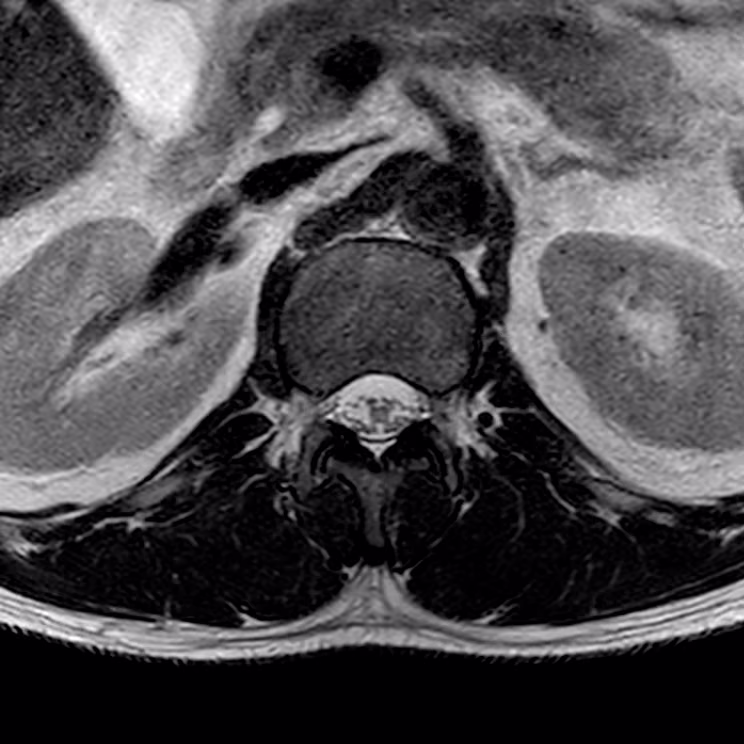 Lumbar spine, axial T2 STACK, conventional scan