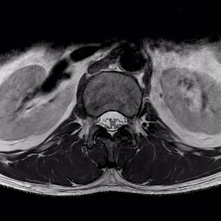 Lumbar spine, axial T2 STACK, SwiftMR scan