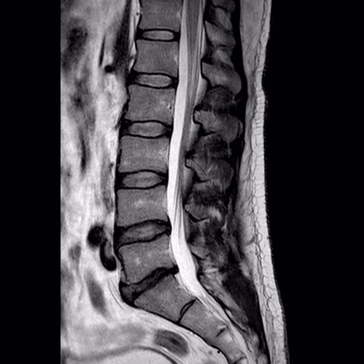 Lumbar spine, sagittal T2, conventional scan