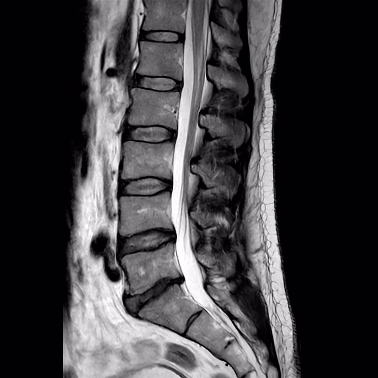 Lumbar spine, sagittal T2, SwiftMR scan