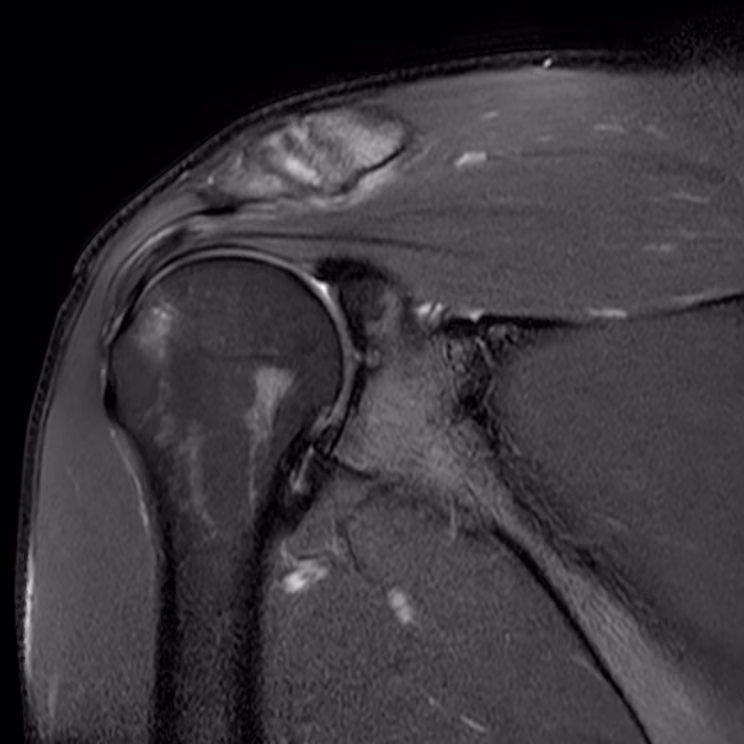 Shoulder, coronal T2 FS, conventional scan