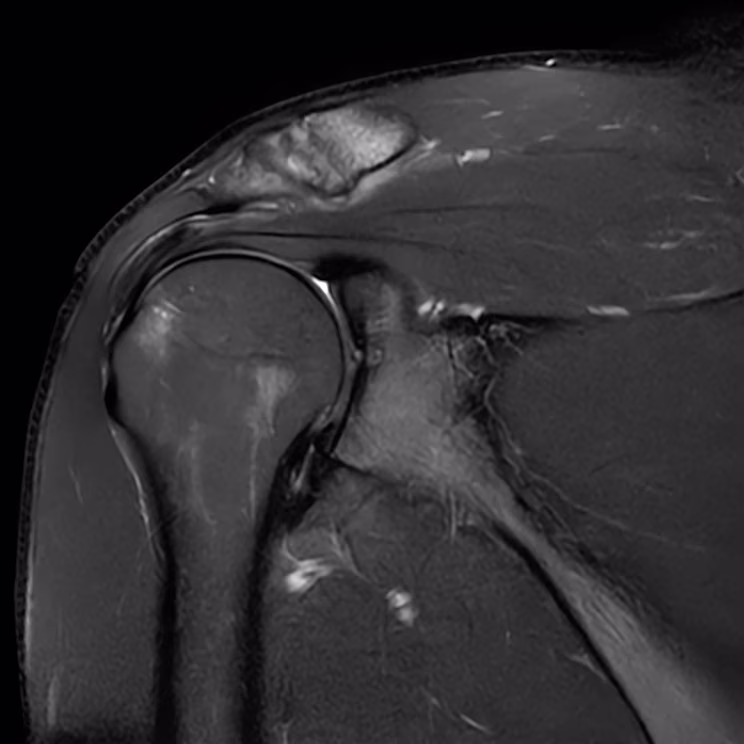 Shoulder, coronal T2 FS, SwiftMR scan