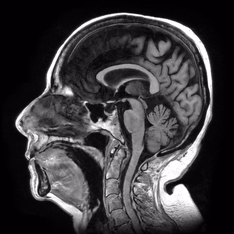 Brain Sagittal, SwiftMR