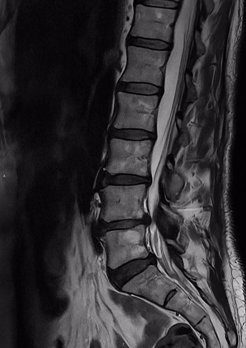 Spine — AiCE + SwiftMR