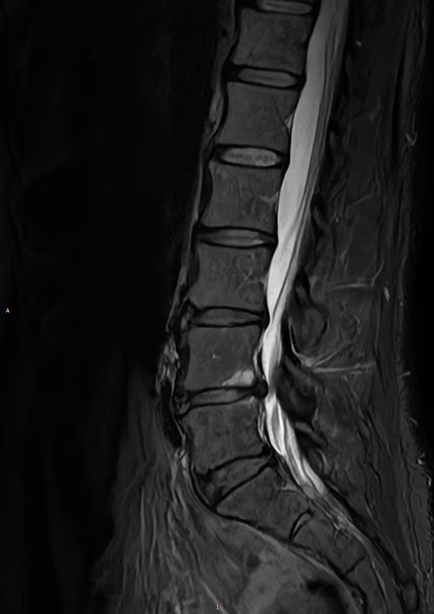 Spine — AiCE + SwiftMR