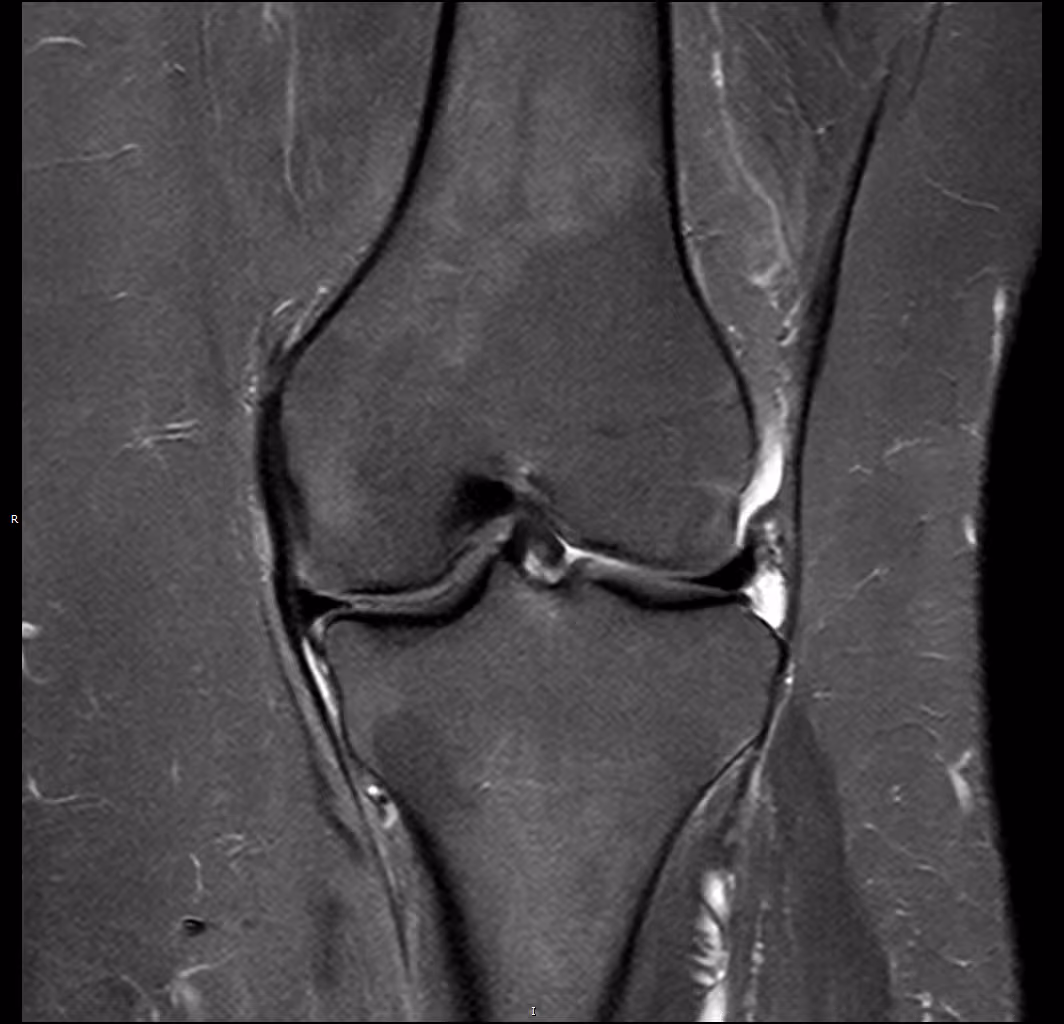 Knee — SwiftMR