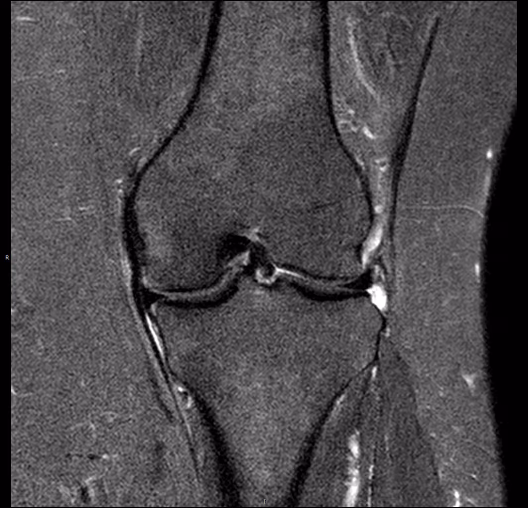 Knee — Conventional