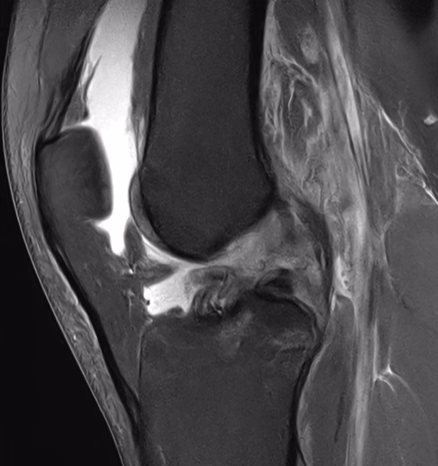 Knee, ACL rupture