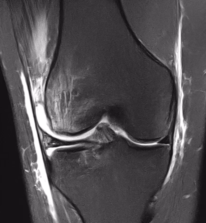 Knee, ACL rupture