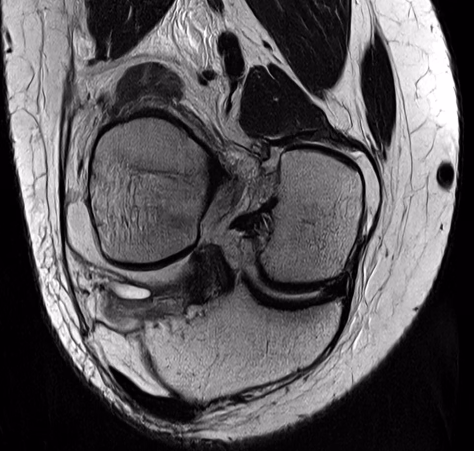 Knee, ACL rupture