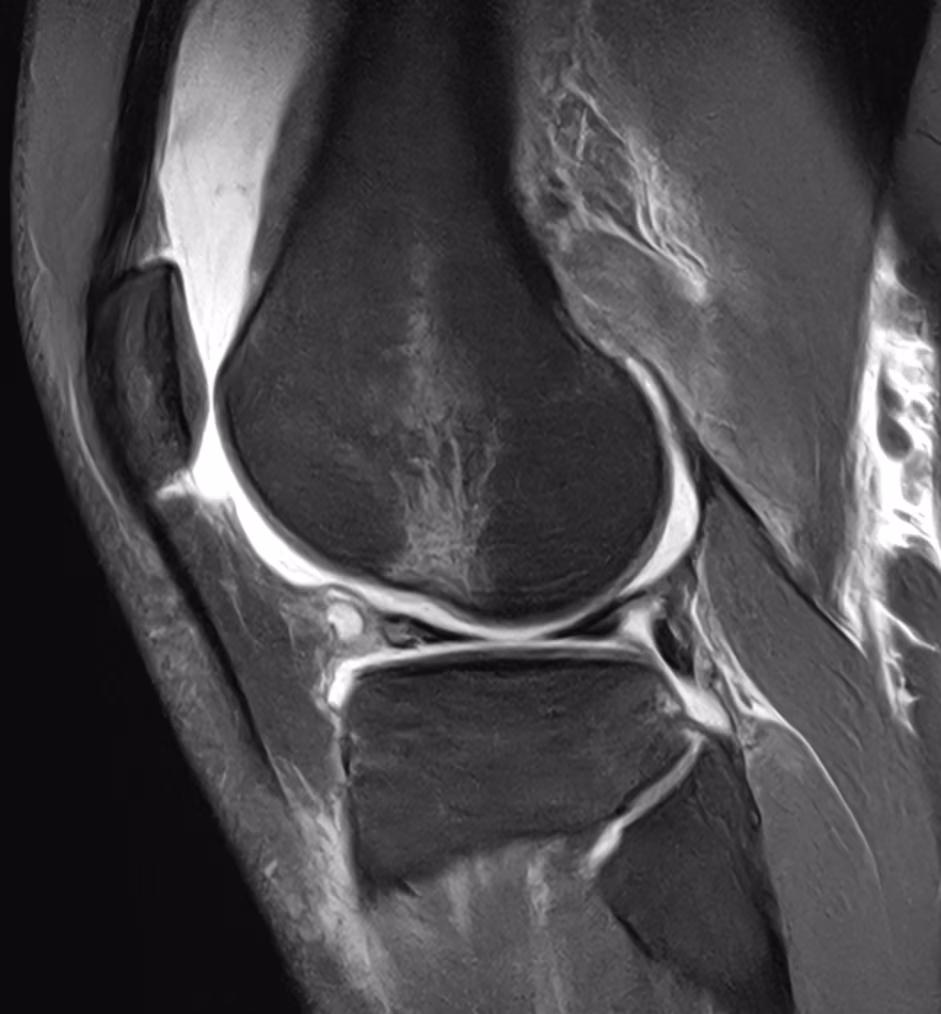 Knee, ACL rupture