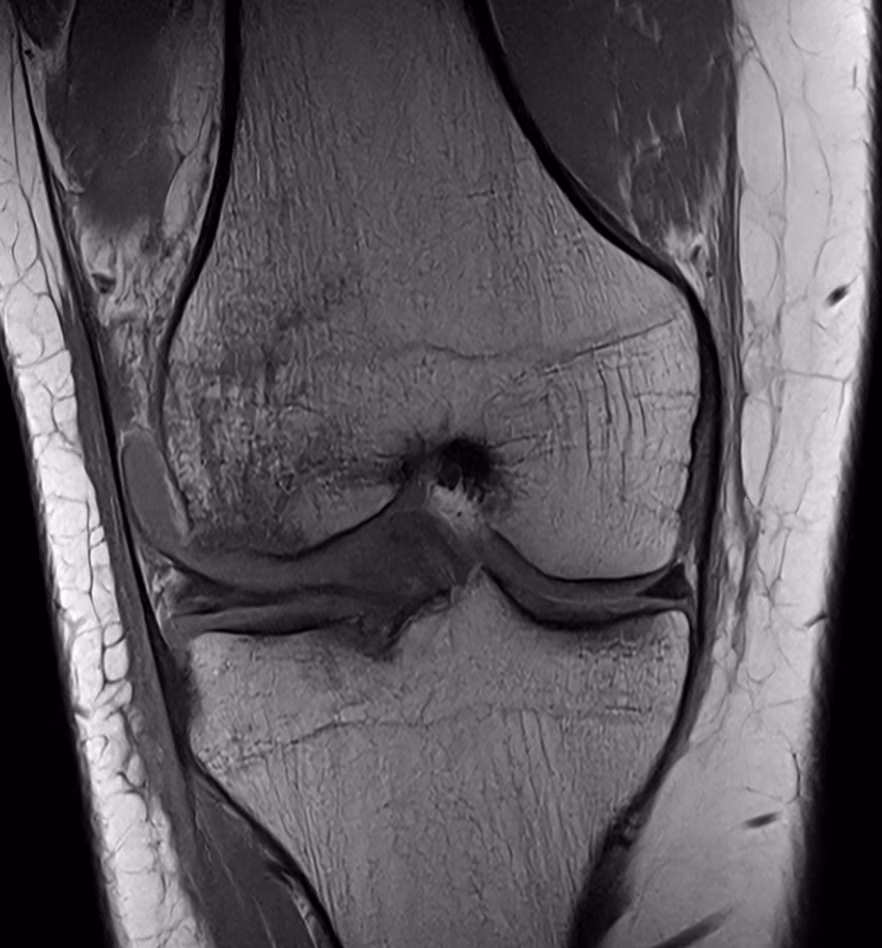 Knee, ACL rupture