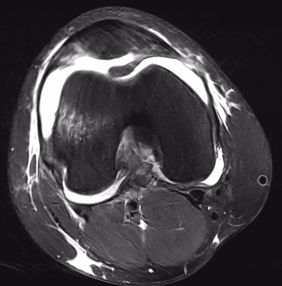 Knee, ACL rupture