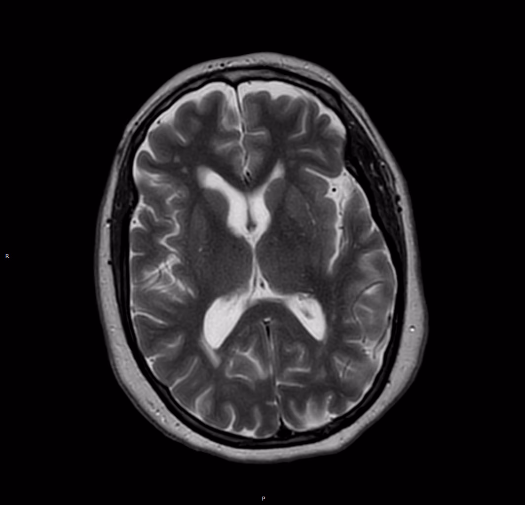 Brain — Philips Ambition X, no AI